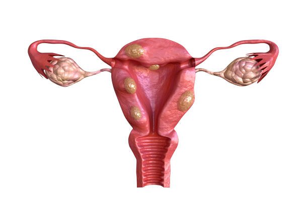 PCOD / PCOS / Cyst / Fibroid Treatment
